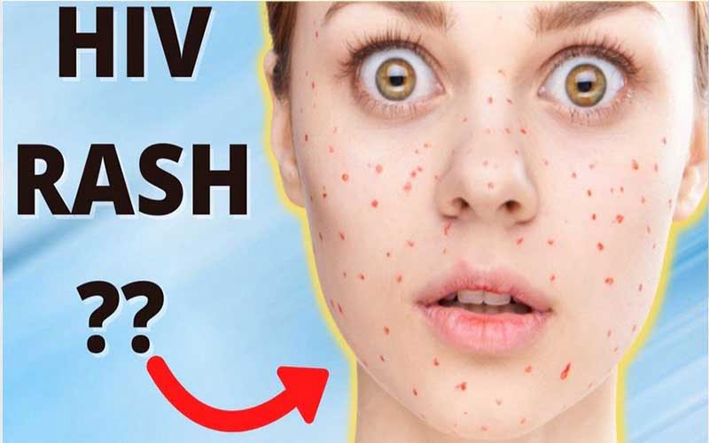 HIV Rash: Causes, Symptoms...