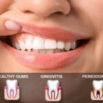 How to Cure Gum Disease With...