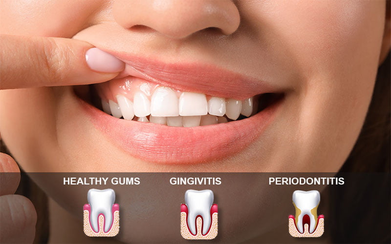 How to Cure Gum Disease Without a Dentist: Natural Remedies