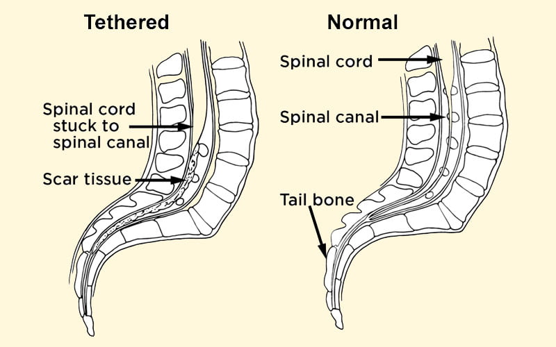 Tethered Spinal Cord: Condition, Symptoms, and Treatment